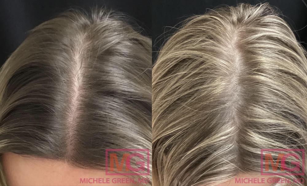 1 year PRP Before and after