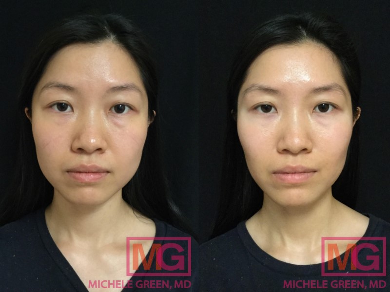 EW 28 F botox masseter 2w FRONT