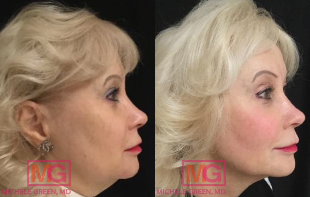 Female with Restylane, Juvederm & Microneedling
