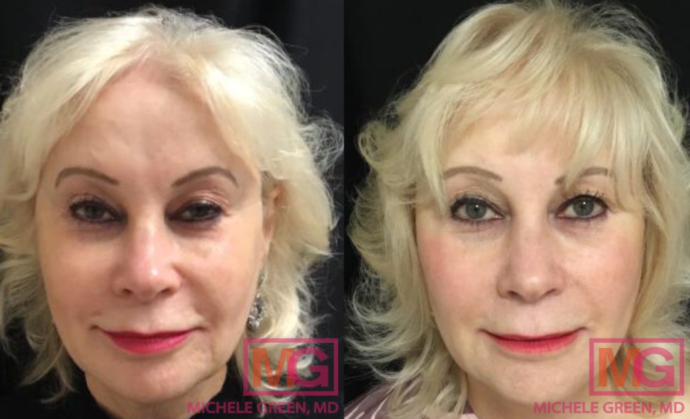 G. W 74 yr old Before After Patient had Juvederm Ultra Plus Volbella Restylane Lyft MicroneedlingFRONT MGWatermark