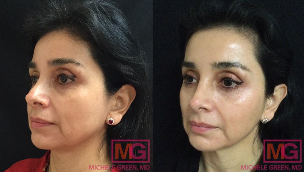G.A 48 2 month Before and After VBEAM 2 Sessions ANGLEL MGWatermark