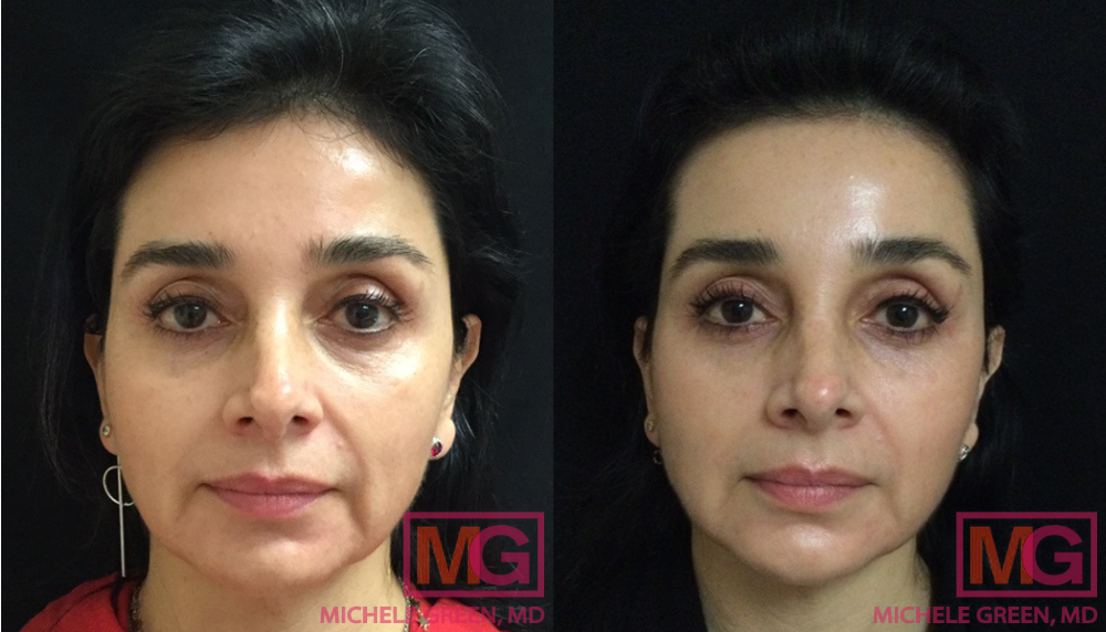 G.A 48 2 month Before and After VBEAM 2 Sessions FRONT MGWatermark