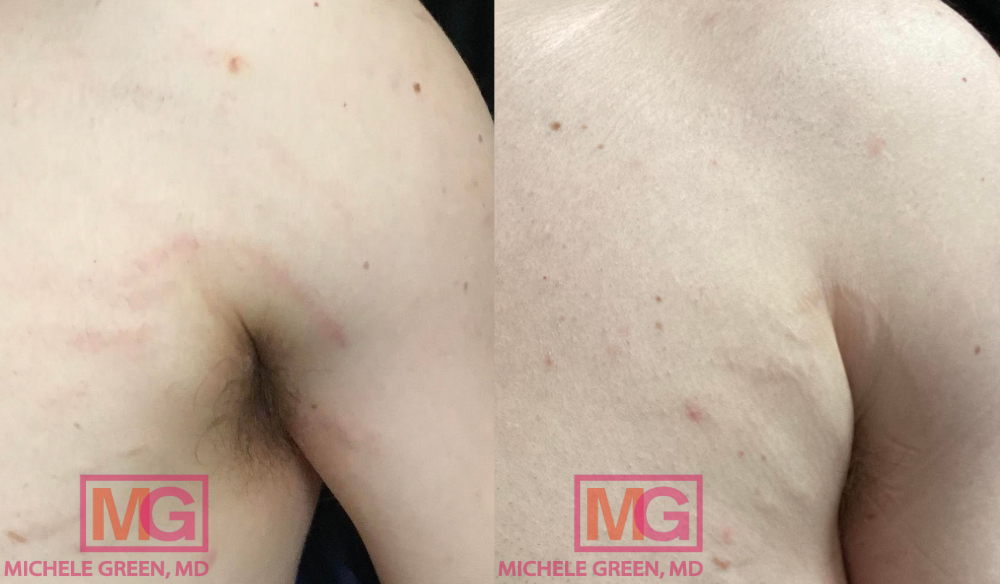 GB 28 yo male before after 4 sessions VBEAM 5 months Armpit MGWatermark