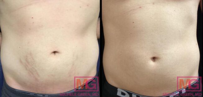 View of Stretch Mark Removal NYC, Laser Stretch Mark Removal Procedures