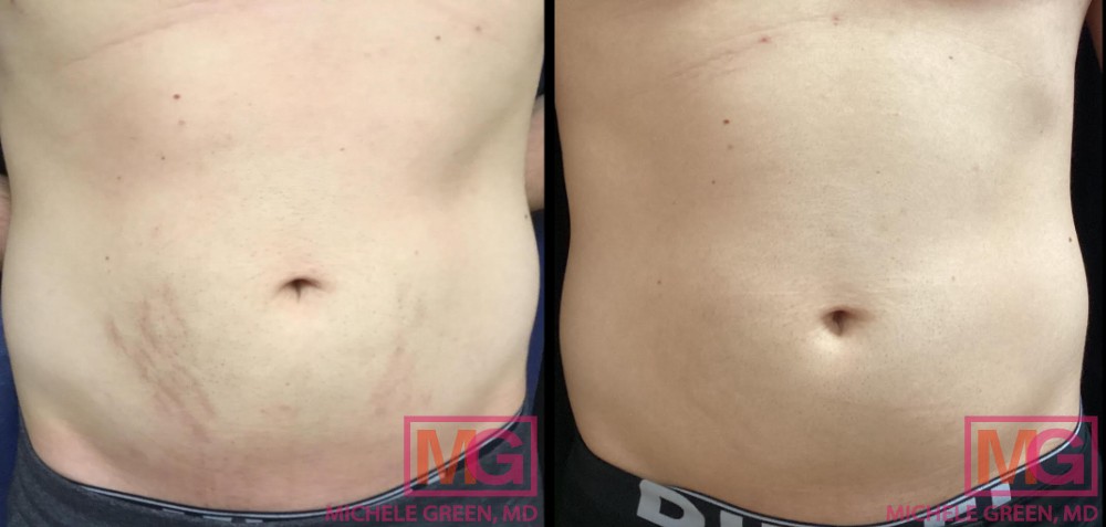 GB 28 yo male before after 4 sessions VBEAM 5 months Stomach Front MGWatermark 1