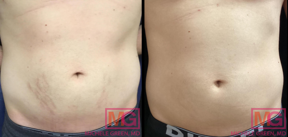 GB 28 yo male before after 4 sessions VBEAM 5 months Stomach Front MGWatermark