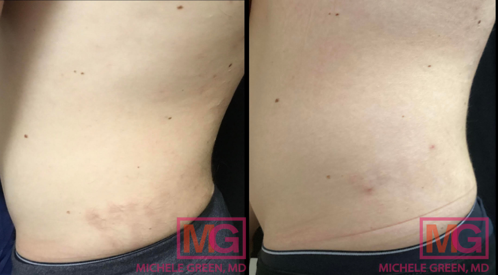 GB 28 yo male before after 4 sessions VBEAM 5 months profile MGWatermark