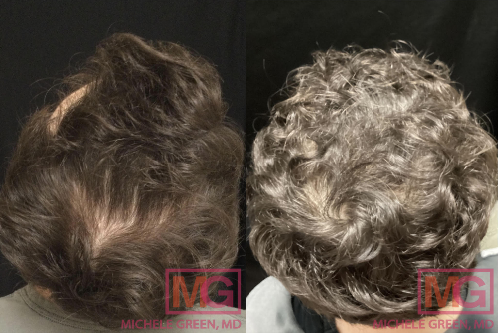 GK 22 yo male before after PRP for hair 7 months MGWatermark