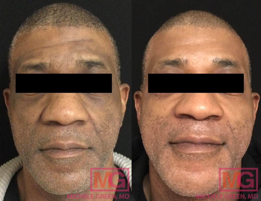 50 year old male before and after Cosmelan treatment - 3 months
