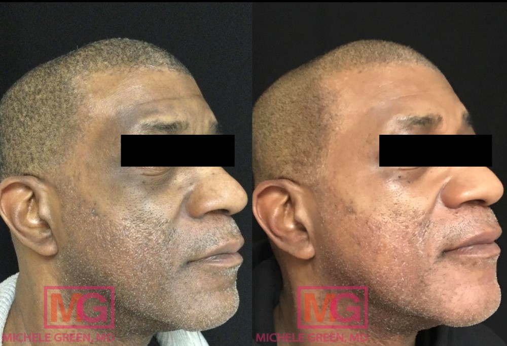 50 year old male before and after Cosmelan treatment - 3 months
