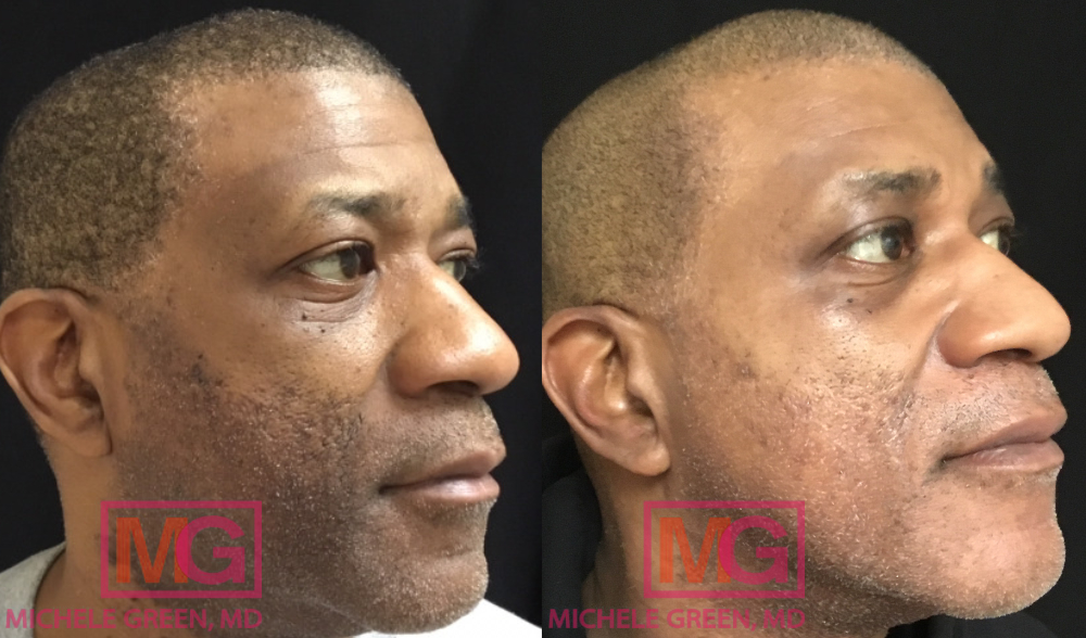 GR 52 years facial pigmentation treatment MGWatermark