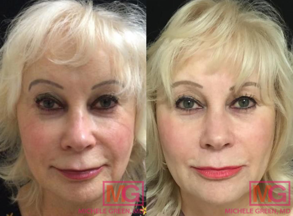 Female before and after, Botox and Dermal Fillers