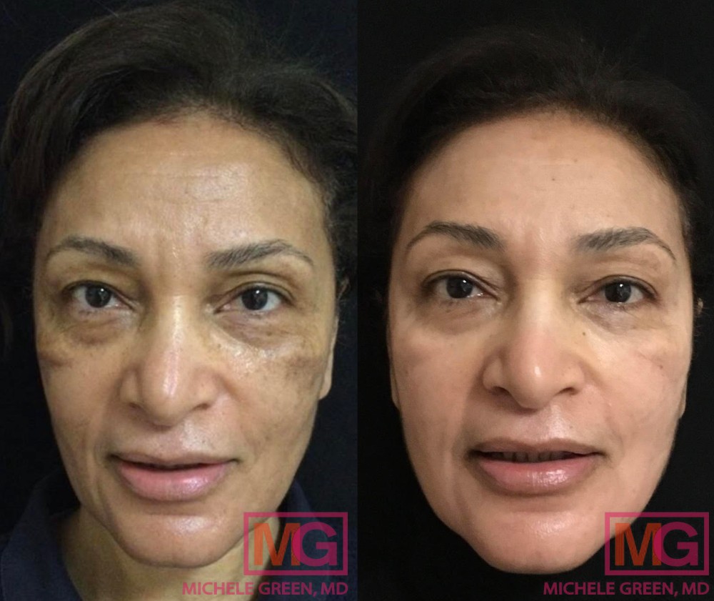 Female treated with Cosmelan & Chemical peels - 3 months