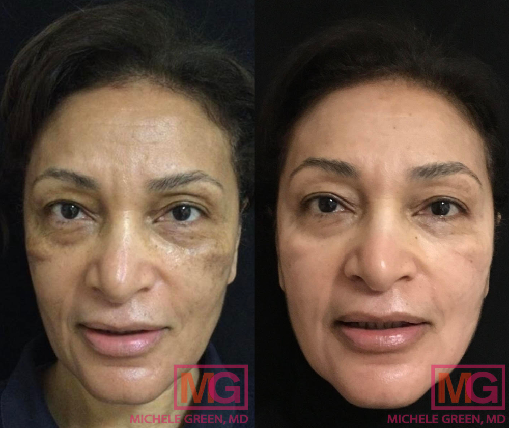 64 year old female before and after 1 Cosmelan treatment - 3 months
