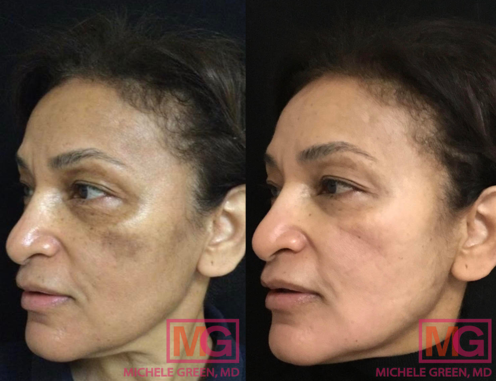 HA 64yo female before after 1 Cosmelan 3 months apart LEFT MGWatermark