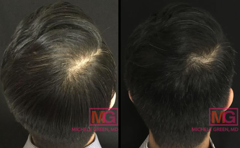 Male with PRP Treatment (4 treatments)