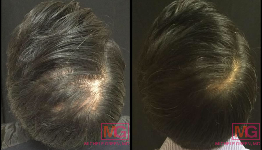 Male 35-44 years old, PRP treatments 15 months after