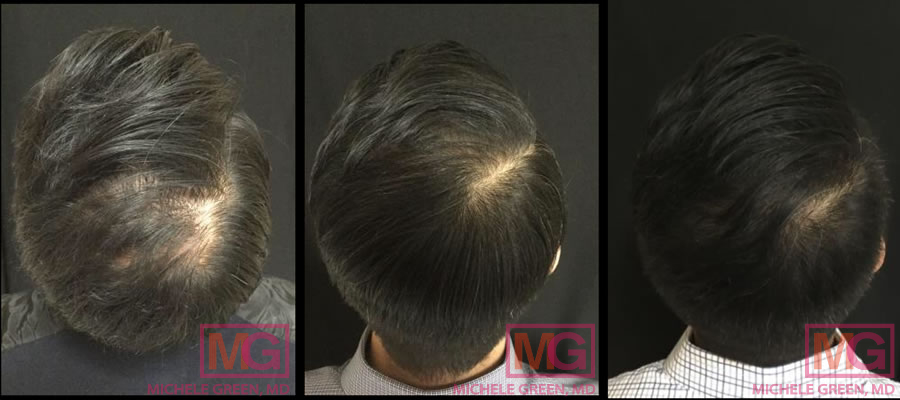 Before and after 3 months and 10 months - PRP hair treatment