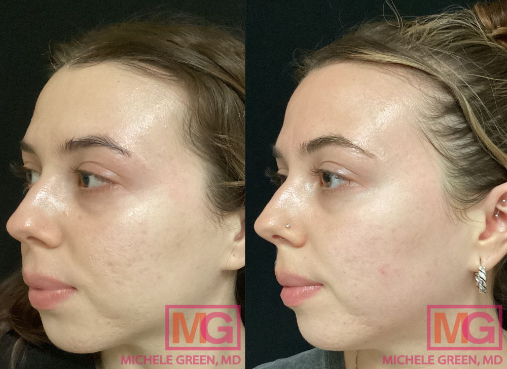 28 yo female Before & After 6 Fraxel Treatments
