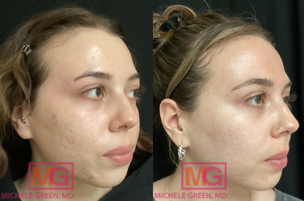 IK 28 yo female Before & After 6 Fraxel Treatments RIGHT MGWatermark