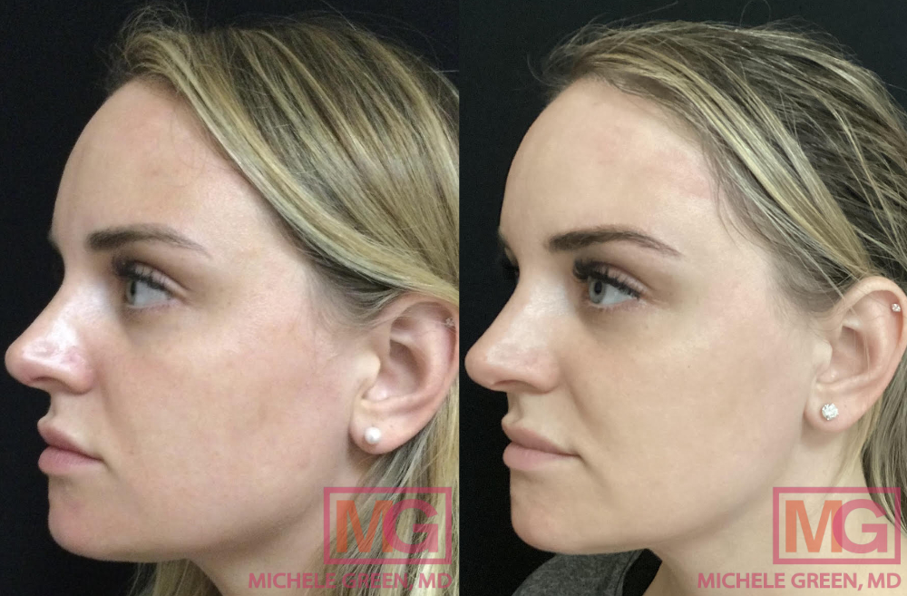 VBeam 1 session - 8 months before and after