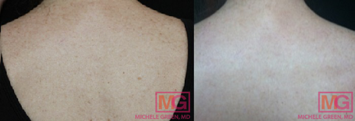45-54 year old woman treated with age spots treatment