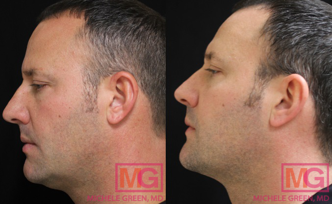 IMAGE06 35 44 year old man treated with kybella MGwatermark