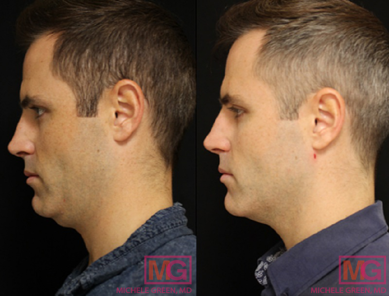 Kybella for a Chiseled Jawline, Utah Facial Plastics