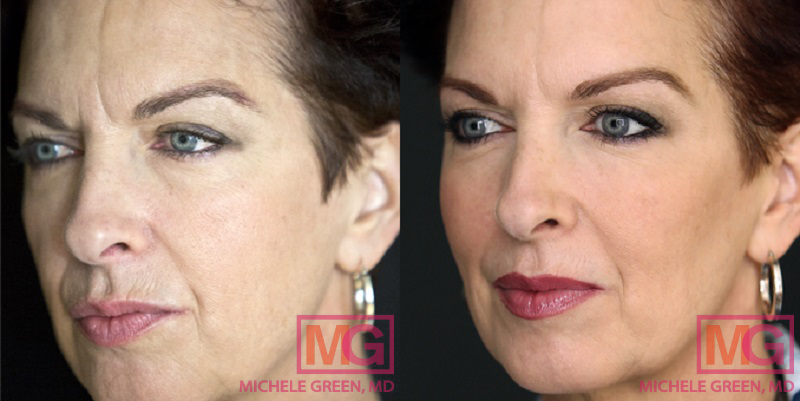 Botox Before And After Photos Patient Photo Pictures