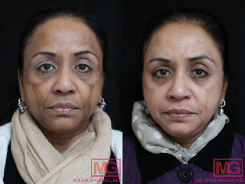IMAGE20 55 64 year old woman treated with chemical peel front view MGwatermark