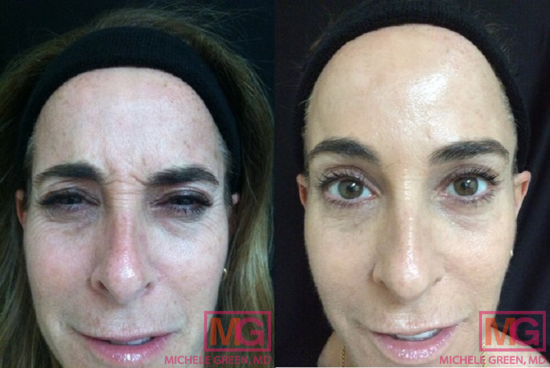 Female treated with Botox in Forehead and Crows Feet