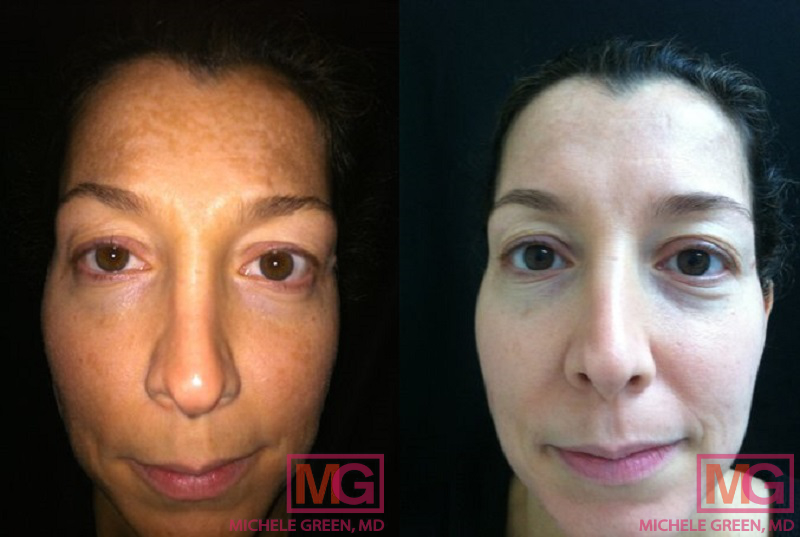 35-44 year old woman treated with Cosmelan