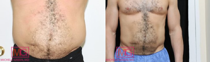 IMAGE29 male coolsculpting treatment on the body MGwatermark