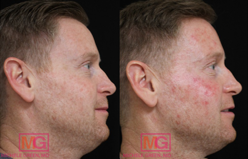 35-44 year old man treated with photodynamic therapy