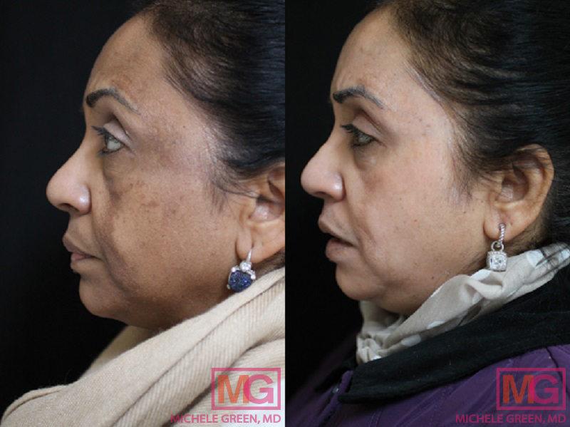 IMAGE34 chemical peel treatment to improve skin condition MGwatermark