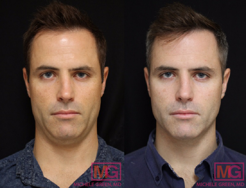 CoolSculpting Before & After Photos, Neck, Chin, Stomach