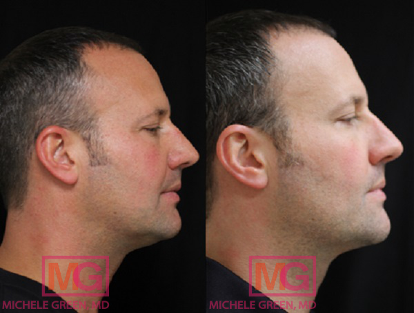 35-44 year old man treated with kybella