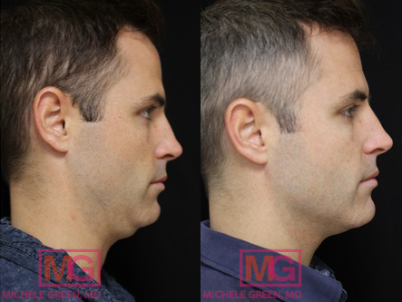 Kybella before and after, male