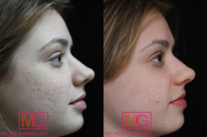 25 34 year old woman treated with acne scars treatment 