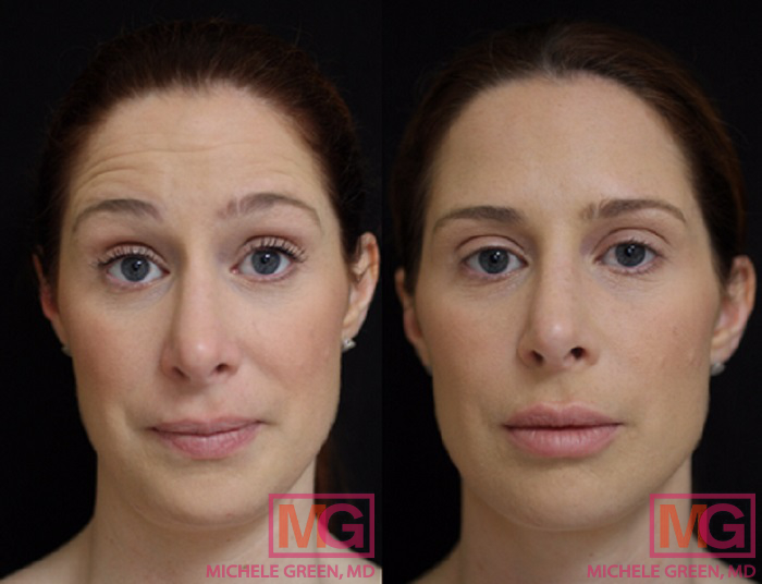 35-44 year old woman treated with Restylane Lyft