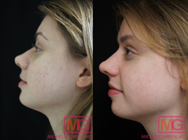 25-34 year old woman treated with acne scar treatment