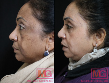 55-64 year old woman treated with Cosmelan
