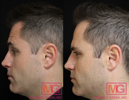 25-34 year old man treated with Botox