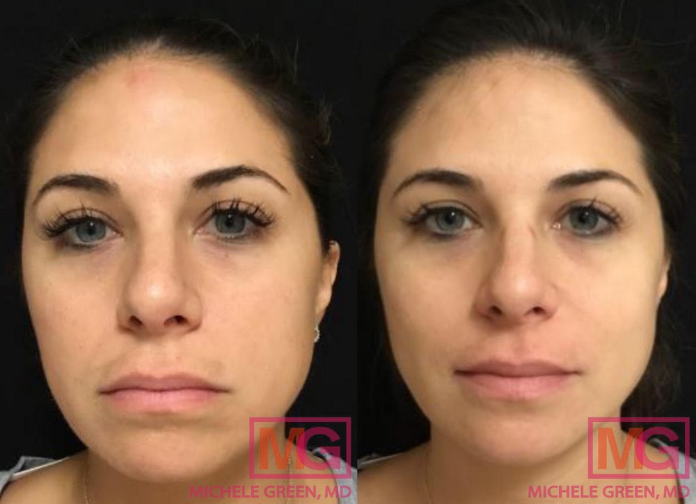 J. G. 39 yr old female Before After 1 Chemical Peel 3 weeks After MGWatermark