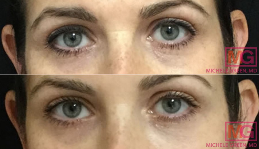 J.A 2 week Before and After Juvedern Voluma Cheeks 1 syringe RestylaneUnder the eyes 1 syringe WEBSITE MGWatermark