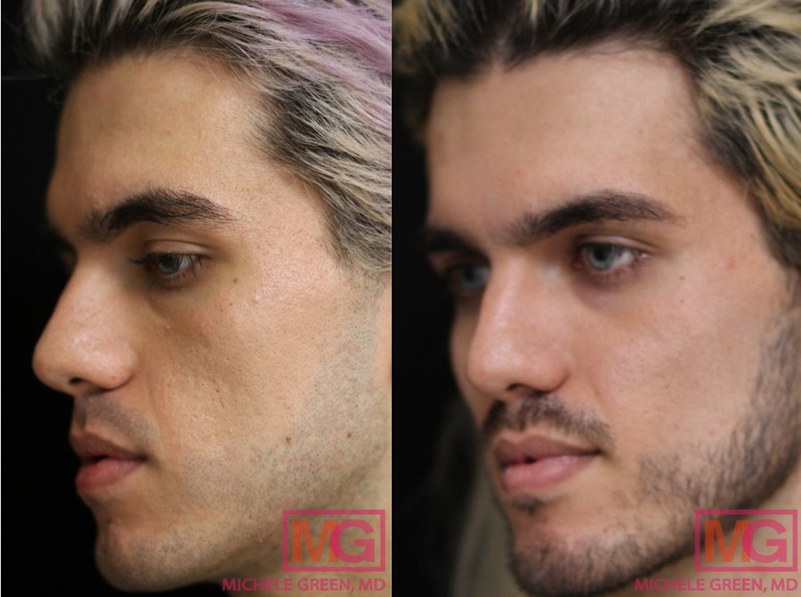 J.A 24 1 month Before and After Juvederm Voluma 2 syringe ANGLEL MGWatermark