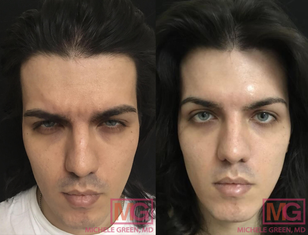 JA 28 yo male before and after Botox MGWatermark
