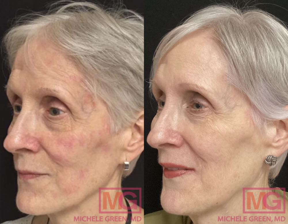JA 70 yo female before and after VBEAM 11 months ANGLE L MGWatermark