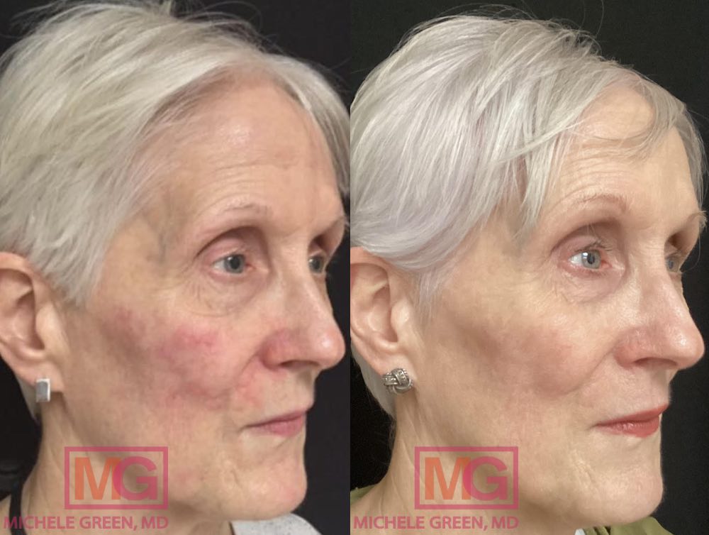 VBeam treatment - 11 months before and after