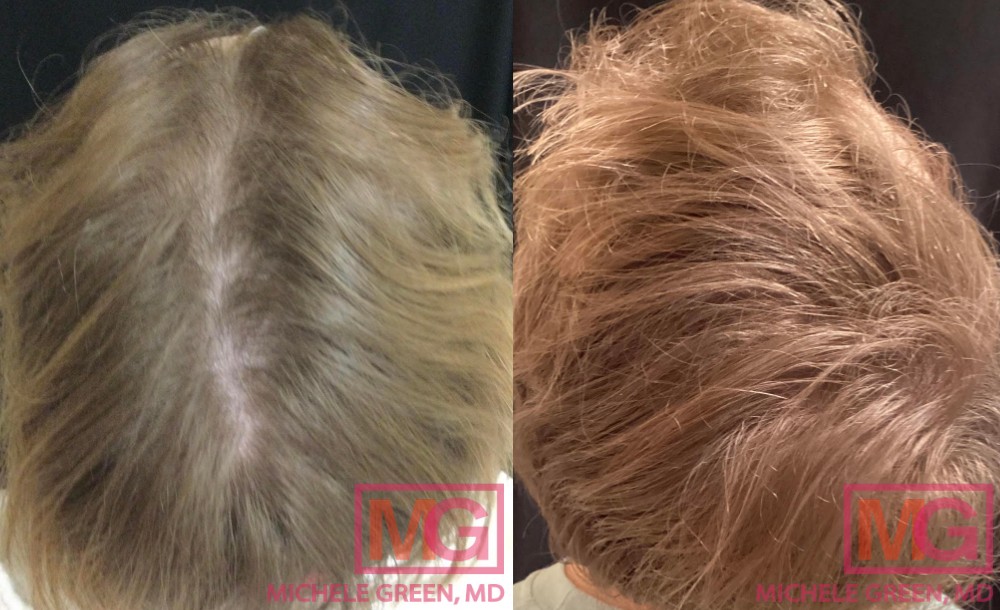 Before and after PRP - 3 sessions